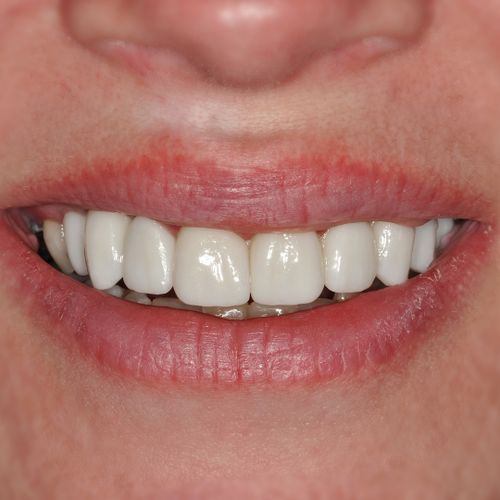 Implants, crowns, bridges - Lindsey Feeney - after - 3dental